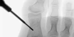 Minimalinvasive Akin Osteotomie