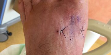 Abbildung 12: Als nächster Schritt erfolgt die dorsale Osteotomie.  Zu beachten ist, dass keine Hebelkräfte aufgewendet werden. Auch hier wird die Osteotomie mit dem Bildverstärker kontrolliert.