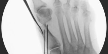 Minimalinvasive Chevron- und Akin-Osteotomie